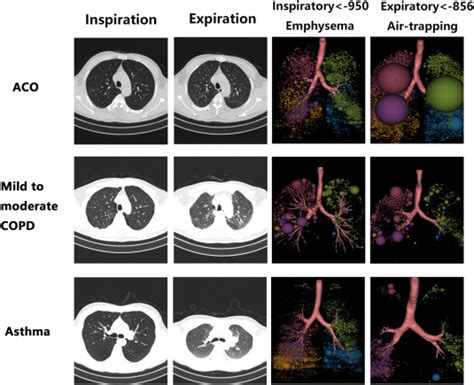 The emerging role of quantitative imaging in asthma .